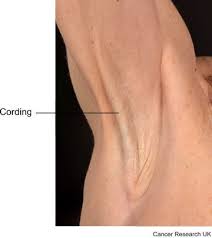 Many possible reasons for armpit or pain under left armpit and shoulder (alluded to therapeutically as axillary agony) can go from generally a disturbance. Possible Problems After Mastectomy Breast Cancer Surgery Cancer Research Uk