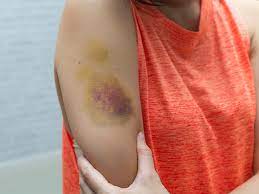 How To Get Rid Of Hickies Fast: 8 Tips And Tricks