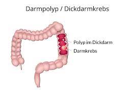 Darmpolypen Adenome Ursachen Symptome Therapie