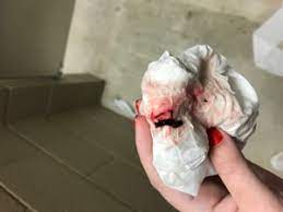 Blood Clot Or Mucus Plug Pic Included February 2018 Babies Forums What To Expect
