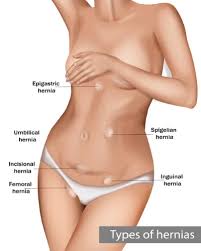 Image result for stomach hernia symptoms