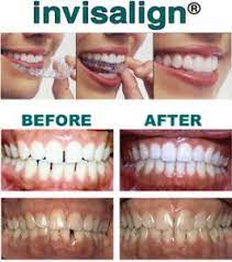With invisalign, it uses a series of plastic aligners to push the teeth for better alignment. Orthodontics Prince Frederick Md