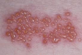 Image result for Varicella zoster on human skin