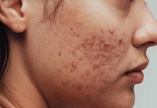 Breakouts & acne's