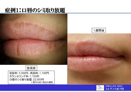 唇 シミ レーザー