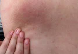 Image result for heat rash under breasts