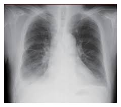 The pleura and pleural spaces are only visible when abnormal. Figure 1 Bilateral Pleural Effusions As An Initial Presentation In Primary Sjogren S Syndrome