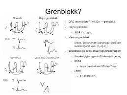 Rytmeforstyrrelser og vurdering av disse. Velkommen Til Ekg Seminar Ppt Video Online Laste Ned