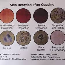 Cupping Skin Reaction Chart Yelp