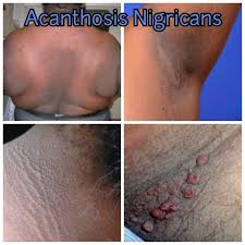 Namun, gatal kimia seperti yang disebabkan oleh gigitan nyamuk atau reaksi alergi tidak ditularkan oleh neuron yang sama. Ramai Salah Faham Hitam Celah Badan Sebenarnya Daki Dr Tampil Beri Penjelasan Dan Cara Rawatan