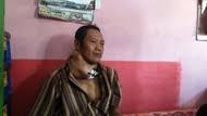 Contohnya pada penyakit tiroiditis hashimoto (goiter) dan tiroiditis atrofi (non goiter), karena operasi pengangjatan kelenjar. Ingat Kanker Tiroid Bisa Disembuhkan Dengan Pengobatan Yang Tepat