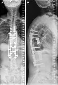 Recurrences are due to cells that have presumably escaped from the original tumor before diagnosis and/or treatment and have become established elsewhere in the body. Operative Treatment Of Metastatic Breast Cancer In The Spine With Regard To Molecular Phenotypes