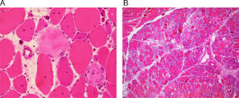 The entire process was very smooth, from the. Immune Mediated Necrotising Myopathy A Critical Review Of Current Concepts Sciencedirect