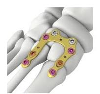 Itval U-shape Locking Plate,Medical Device Manufacturers ...