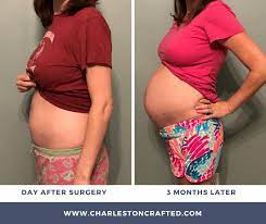 My Experience Having A Dermoid Ovarian Cyst Removed During Pregnancy