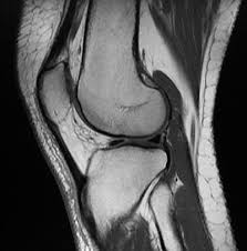 A knee mri looks specifically at your knee and its surrounding areas. Stem Cell Therapy And Prp For Knee Joint Pain Regenexx