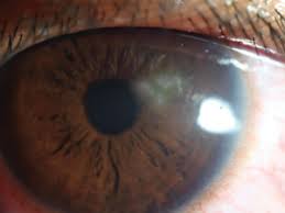 Disciform keratitis is a primarily inflammatory condition caused by a hypersensitivity reaction to the herpes simplex viral. Don T Let Hsk Heterogeneity Fool You