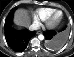 Pleural mesothelioma is a rare type of cancer that causes the abnormal and malignant cell growth of the pleural layer of the lungs. Asbestos Related Pleural Mesothelioma Doccheck