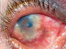 Image result for Vernal Conjunctivitis