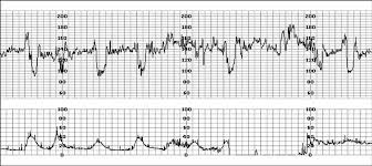 Image result for Late Deceleration