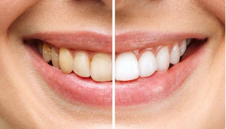 Teeth Whitening product image