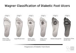 Image result for IDSA Diabetic Foot Wound Classification