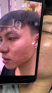 Giải pháp trị mụn thâm hiệu quả từ Acne Derm