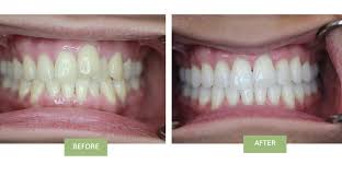How much does invisalign cost? Invisalign Nyc Top Invisalign Dentist In New York City