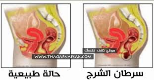 احذر من السرطان الشرجي أسبابه أعراضه طرق علاجه والوقاية ثقف نفسك