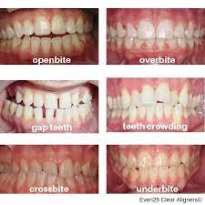 Check spelling or type a new query. 4 Questions To Help You Decide If You Qualify For Clear Aligners Even28 Dentist Search Engine
