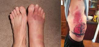 Common Muay Thai Injuries How To Treat Bruised Ribs Shin Splints And More Muay Thai Guy Muay Thai Bruised Ribs Shin Splints