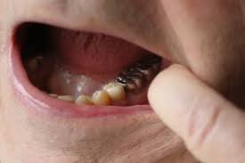 Removable dentures and dental bridges are now sometimes considered to be less desirable treatment options as compared to dental implants, because of. Bamboozled What Happens To Gold Teeth When Someone Is Cremated Nj Com
