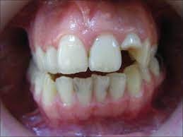 Maybe you would like to learn more about one of these? Gigi Palsu Permanen Untuk Gigi Patah Audy Dental