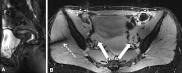 6.1a, b) is a bony ring consisting of paired innominate bones, the sacrum and coccyx. 7t Mri Successfully Images The Female Pelvis