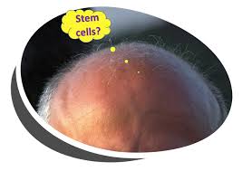 Hair loss is a common frustration among many adults. Stem Cells For Baldness Any Progress In 2019 The Niche