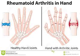 Diagram Showing Rheumatoid Arthritis In Hand Stock Vector