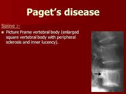 Visibility, versatility and stability during lumbar surgery. Bone Infection Ppt Video Online Download