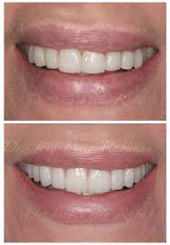 Bonding vs veneers for more natural looking teeth. What Makes Porcelain Veneers Look Natural Cosmetic Dentistry San Francisco