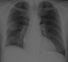 A lateral decubitus film (obtained with the patient lying on their side, effusion side down, with a cross table shoot through technique) can visualize small amounts of fluid contrary to the radiological method, ultrasound allows an easy differentiation of loculated pleural fluid and thickened pleura. Epos