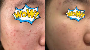 And the brand is not too popular in the uk. A Redditor Says Selsun Blue Dandruff Shampoo Helped Clear Up Her Fungal Acne See The Photos Allure