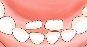 早期発見!注意したい永久歯の生え方 | かつらやま歯科医院|千葉市緑区 土気駅近くの歯医者