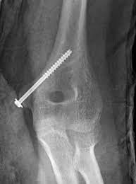 The management of displaced medial humeral epicondyle fractures in children remains controversial. Medial Epicondylar Fractures Pediatric Pediatrics Orthobullets