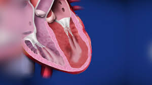 Image result for Cardiomyopathy