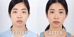 In the frontal area, the . Top Plastic Surgeon Los Angeles Dr Kenneth Kim