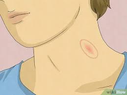 Home focus at hickeys is ireland's leading retailer of curtains, poles, fabrics & bedding. How To Spot A Hickey 8 Telltale Signs
