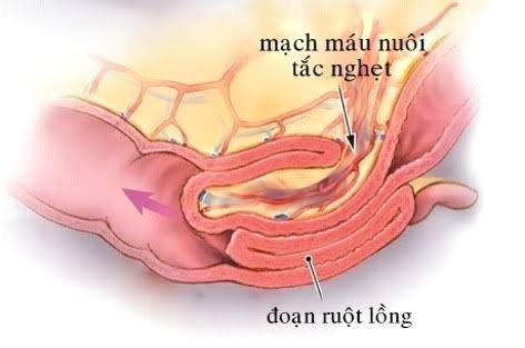 Hình ảnh Lồng ruột (nguồn Internet)
