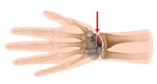 Scaphoid Fracture Symptoms Causes And Treatment Tendons of the extensor pollicis longus lateral scaphoid fracture symptoms causes
