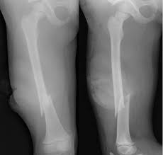 Image result for Fracture XRay