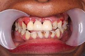 Recht schnell kamen die mädchen und buben dahinter: Loch Im Zahn Behandlung Ohne Schmerzen Centrocc Dental