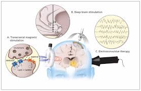 Image result for Refractory Depression Management